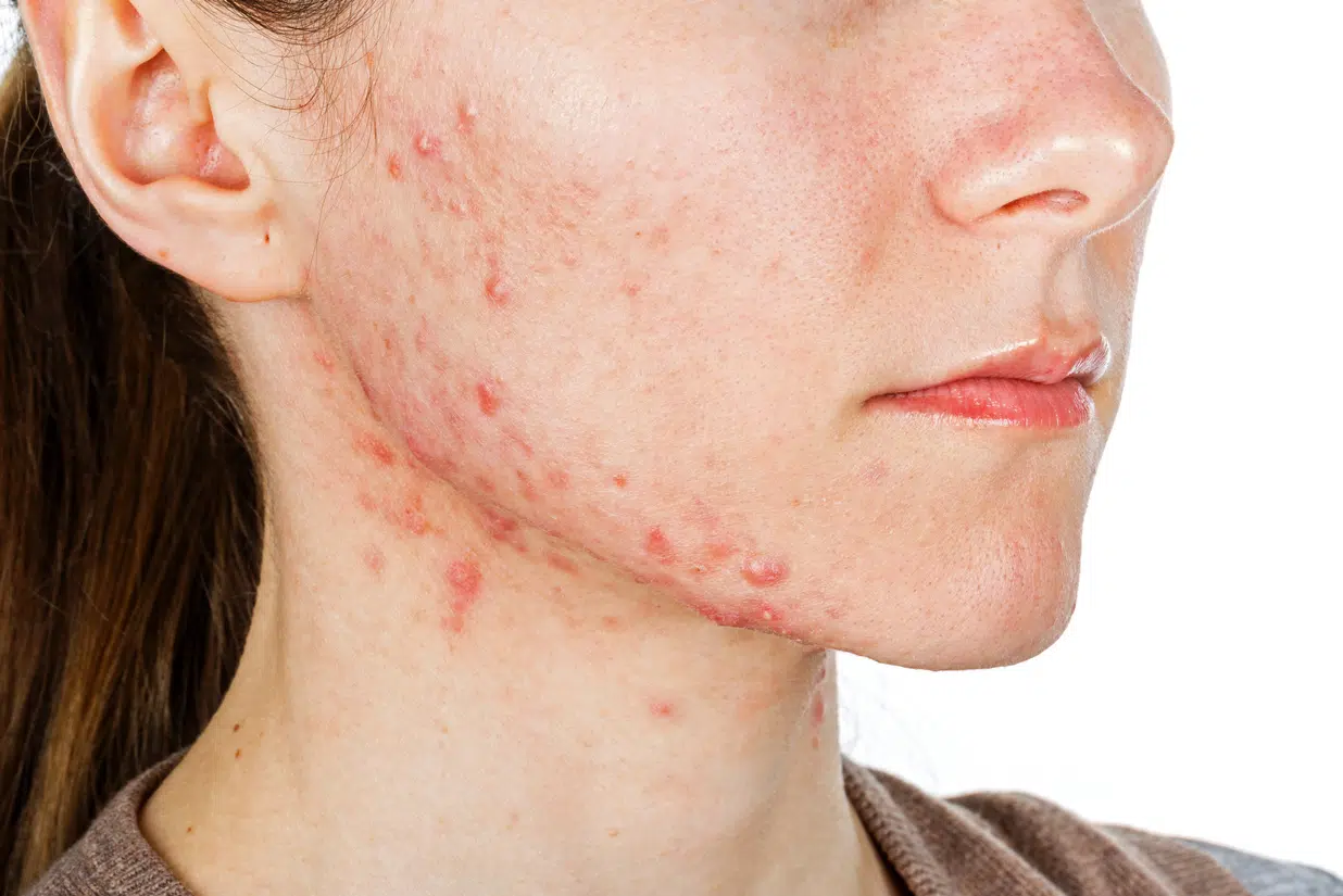 Hormonal Skin Breakouts: Simplify Care and Track Triggers